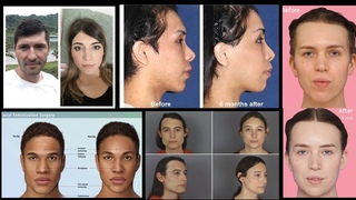 Male to Female (MTF) Facial Feminization