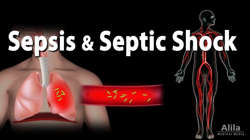 Sepsis and Septic Shock,