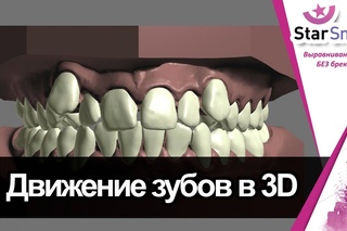 Виртуальный сетап (моделирование улыбки для элайнеров)★Star Smile★