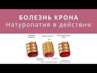 Болезнь КРОНА и язвенный колит (НЯК). Почему болит кишечник
